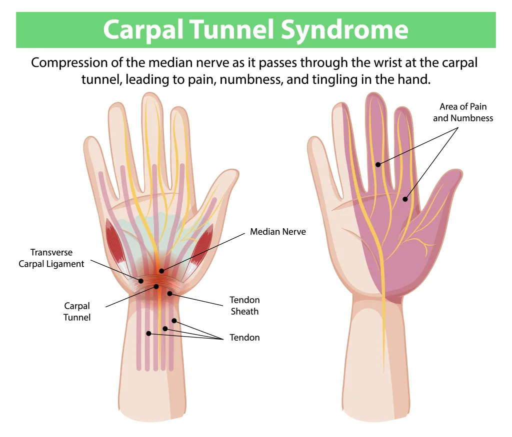 Illustration showing the median nerve passing through the carpal tunnel at the wrist and the areas of pain and numbness in the hand